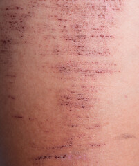 Wounds on the skin. Deep scratches on the skin. Wounds