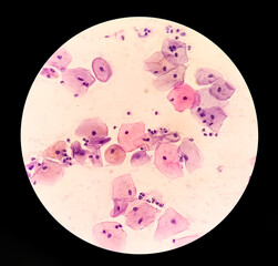 Atypical squamous cells of undetermined significance, it may be a sign of infection with certain types of human papillomavirus (HPV) or other types of infection, such as a yeast infection.