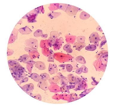 Atypical squamous cells of undetermined significance, it may be a sign of infection with certain types of human papillomavirus (HPV) or other types of infection, such as a yeast infection.
