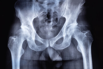 X-ray and MRI, MRT, CT with the human spine with defects in bones and vertebrae. Medical treatmant concept. Diagnosis of the disease spine, hip joint and intervertebral hernia.