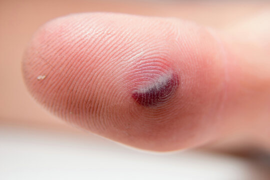 Blood blister under the thumb skin. Caucasian young man finger on white background