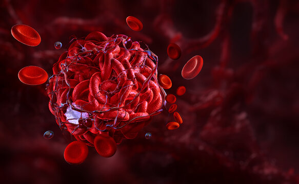 Blood clot in artery, emphasizing thrombosis, coagulation process, red blood cells, fibrin strands. Heart attack, vein disease prevention, diagnosis, treatment in healthcare. Blood clot formation 3D
