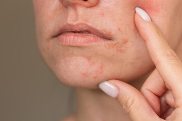 Closeup photo of face of a young Caucasian woman suffering from perioral dermatitis near the mouth....