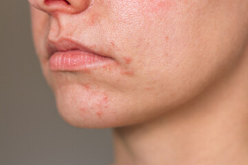 Young Caucasian woman suffering from perioral dermatitis near the mouth. Close up photo. Skin...