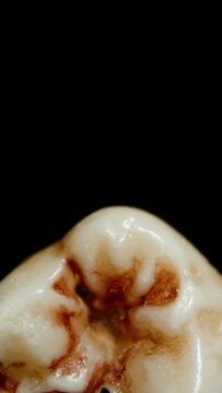 Vertical video. Bloodied Human Tooth on a Black Background, Crown. Macro Zoom.