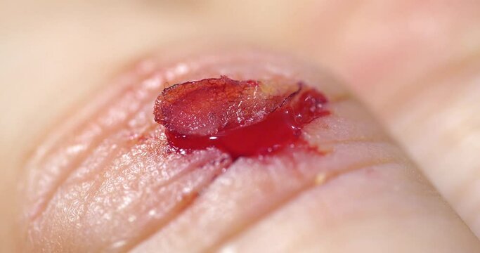 Injury to middle finger of right hand with bleeding. Flayed skin, red blood and lymphatic fluid flows from wound, zoom-in video