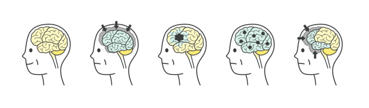 高齢者が認知症によって損傷を受ける脳の部分のイラストのセット