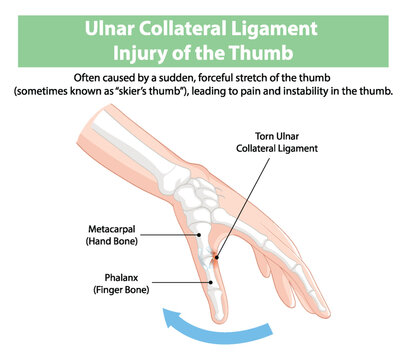 Detailed diagram of thumb ligament injury