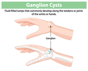 Illustration of ganglion cysts on hands and wrists