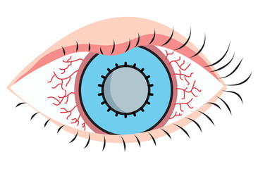 Mucous membrane pemphigoid,Cicatricial,chronic autoimmune causing blistering and scarring of the mucous membranes, including the eyes,Stevens-Johnson syndrom,ocular,Mooren's ulcer,vectors