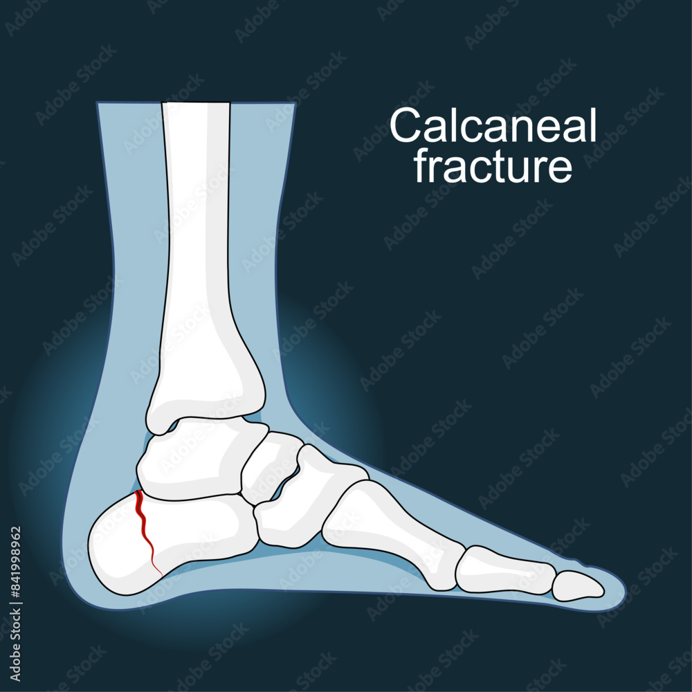 Poster calcaneal fracture. trauma of heel bone.