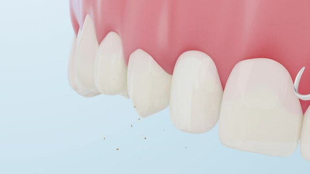 Plaque scraper removes tartar or dental calculus from teeth.
