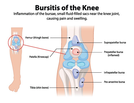 Inflammation of knee bursae causing pain and swelling