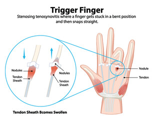 Diagram explaining trigger finger condition
