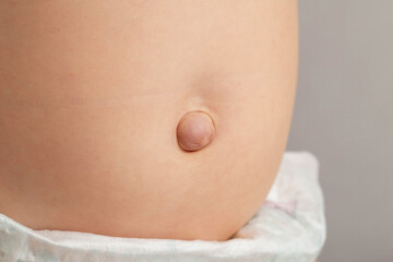 Umbilical hernia in newborns on the stomach, close-up. Treatment of hernias in children without...