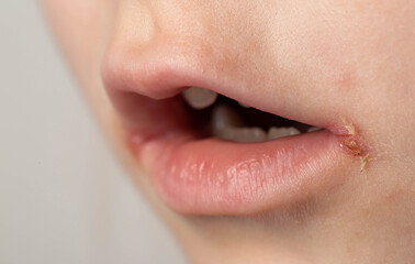 slit-like impetigo in a little girl in the corners of her mouth. Skin wounds. Dermatological bacterial disease. Sticky lips, close-up, angulitis