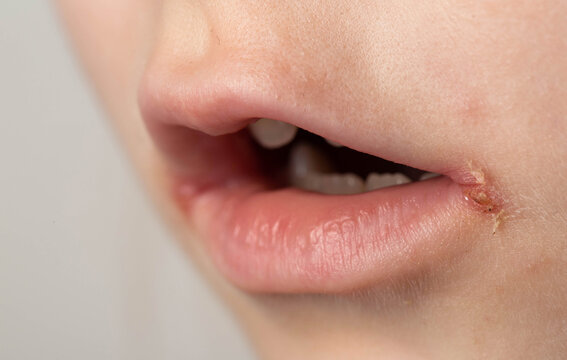 slit-like impetigo in a little girl in the corners of her mouth. Skin wounds. Dermatological bacterial disease. Sticky lips, close-up, angulitis