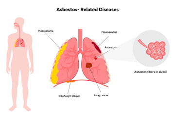 Asbestos-related diseases lungs problem
