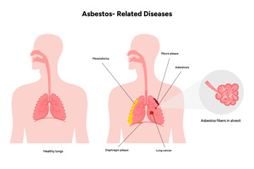 Asbestos-related diseases lungs problem