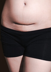 scar of cesarean section in the belly area