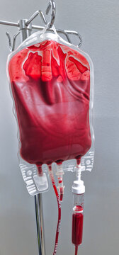 Nahaufnahme eines Erythrozytenkonzentrats auf einem Infusionsst&auml;nder, Bluttransfusion