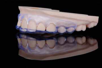 3D printed transparent dental template for gum correction fixed on model on black background.