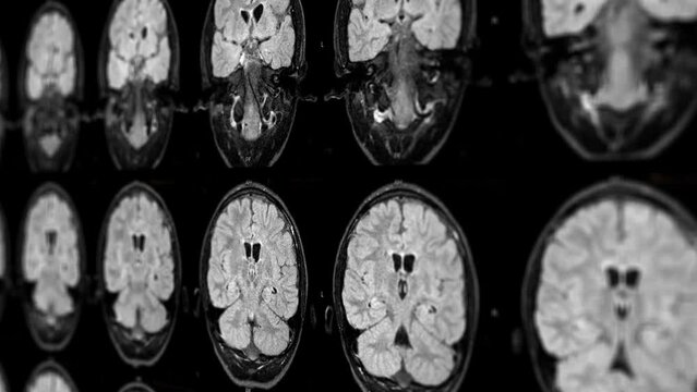 A series of brain scans are shown in a blue background. The scans are of different sizes and shapes, but all have a similar color and texture. Scene is one of curiosity and fascination