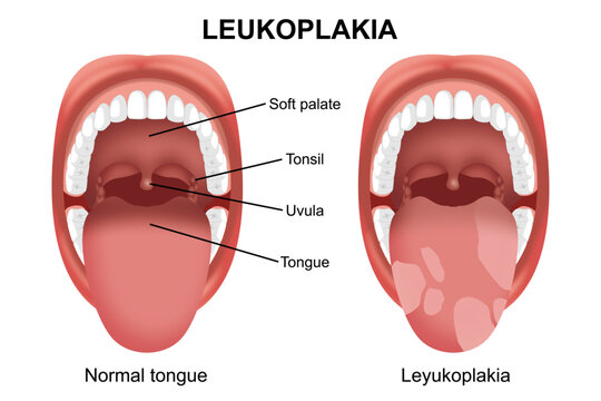 Normal tongue vs Leukoplakia mouth infection illustration