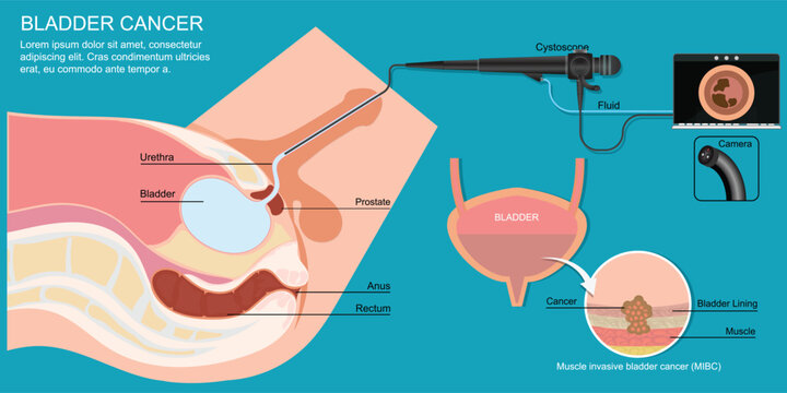 Cystoscopy enables the inside of the urethra and bladder to be examined and sampled.