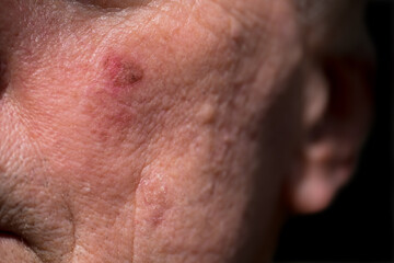 Red crusty lesions of actinic keratosis or sunspots on sun-damaged skin on the cheek under the left...