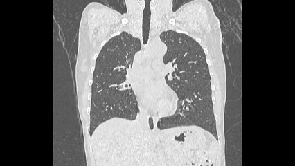 normal  chest Ct scan  lung window