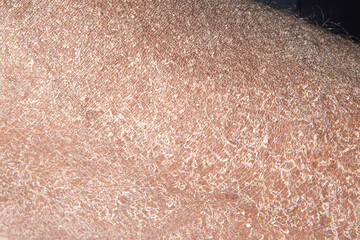 Close-up of a person's skin suffering from severe psoriasis