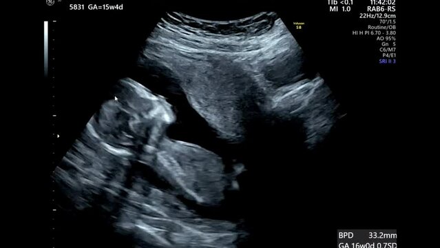 エコー検査＿胎児