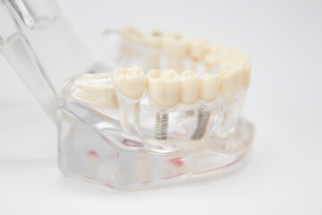 A demonstration jaw with an implant and an abutment