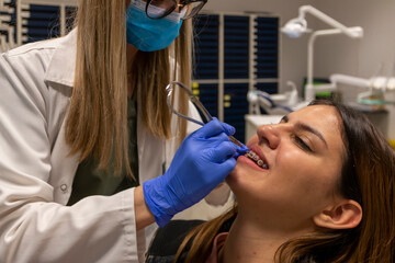 Fototapeta premium Installation process temporary tooth in self-ligating braces for a perfect smile. Orthodontic treatment of teeth. Dental care.