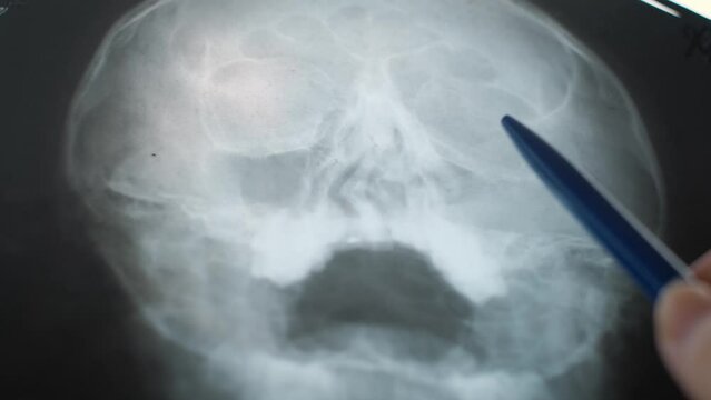 A doctor shows a deviated nasal septum on a patient's picture