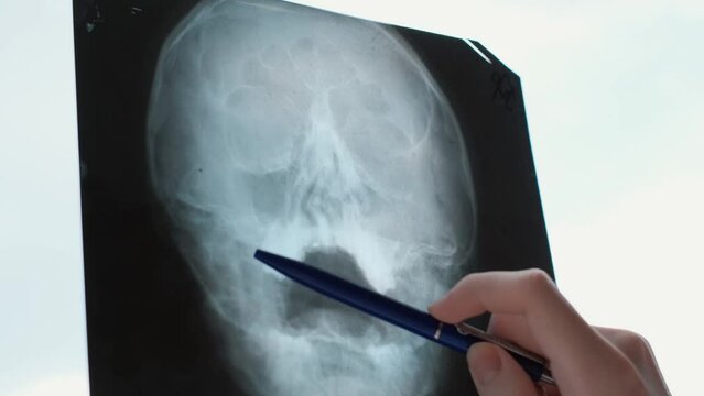 A doctor shows a deviated nasal septum on a patient's picture