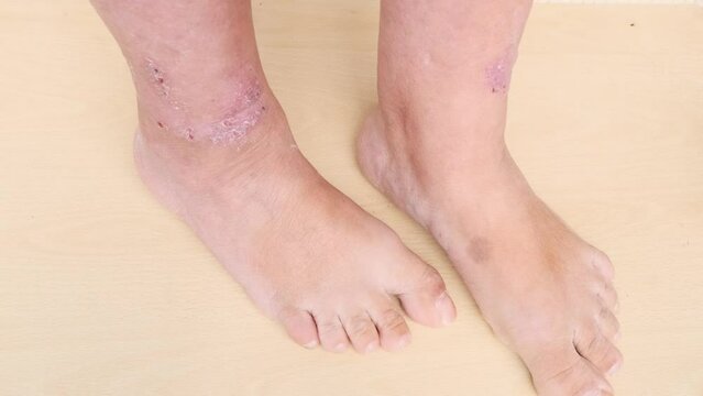 rash, hives, itchy skin on legs, inflammation and Medical Allergies, disease on body of female patient, Dermatology Skin Issues, health care, skin problems on general physical and emotional well-being