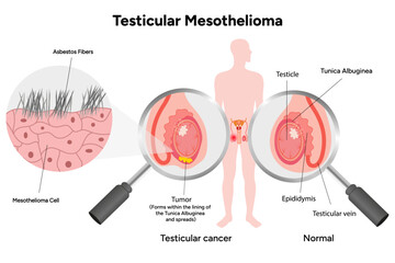Mesothelioma disease, Testicular mesothelioma