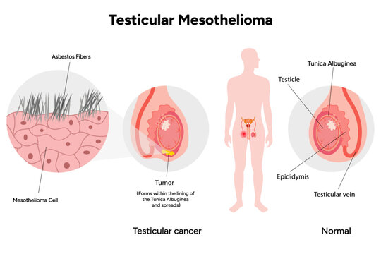 Mesothelioma disease, Testicular mesothelioma - Powered by Adobe