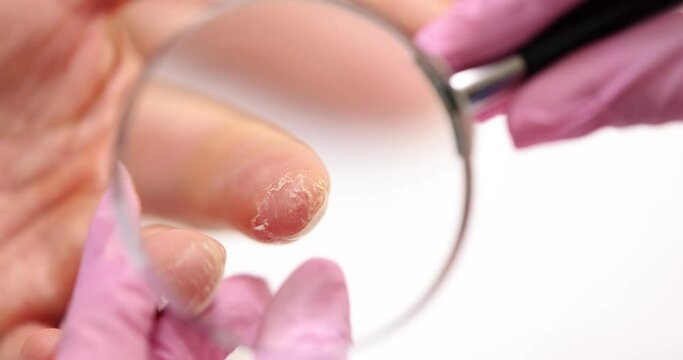 Doctor examines an exacerbation of psoriasis on patient finger