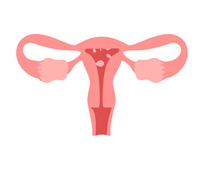 Uterus organ with polyp. Check health of woman organ. Unhealthy, internal problems, female reproductive system disease. Risk growth cancer cells in womb. Vector flat illustration