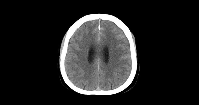 A CT scan of the brain shows a subarachnoid hemorrhage scattered at both frontal lobes, temporal lobes, basal cistern and prepontine cistern., highlighting areas of bleeding.