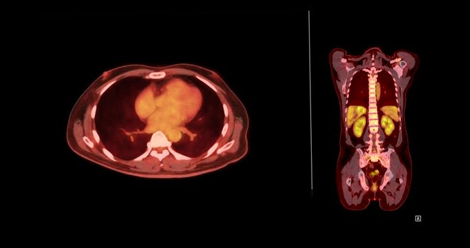 A PET CT scan reveals cholangiocarcinoma with suspected metastatic involvement of the lungs and lymph nodes.
