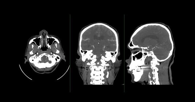 A CT scan of the brain shows a subarachnoid hemorrhage scattered at both frontal lobes, temporal lobes, basal cistern and prepontine cistern., highlighting areas of bleeding.