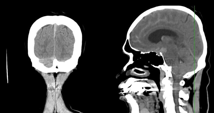 A CT scan of the brain shows a subarachnoid hemorrhage scattered at both frontal lobes, temporal lobes, basal cistern and prepontine cistern., highlighting areas of bleeding.