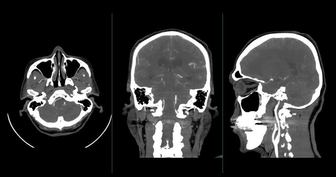 A CT scan of the brain shows a subarachnoid hemorrhage scattered at both frontal lobes, temporal lobes, basal cistern and prepontine cistern., highlighting areas of bleeding.