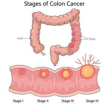 stages of colon cancer with labeled polyps and colon anatomy from stage I to stage IV diagram hand drawn schematic vector illustration. Medical science educational illustration
