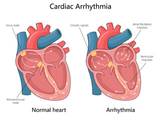 normal heart with cardiac arrhythmia, showing sinus node, chaotic signals, and atrial fibrillation diagram hand drawn schematic vector illustration. Medical science educational illustration