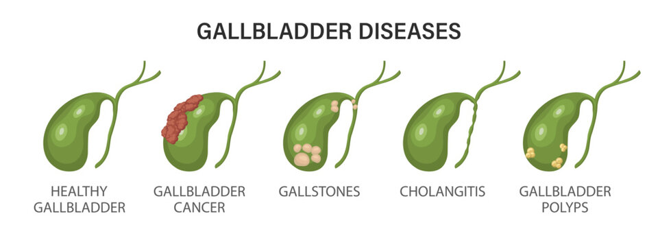 Gallbladder diseases infographics. Gallstone disease, cancer, acute cholecystitis, cholangitis or polyps of the digestive system. Problems with the biliary tract. Illustration.